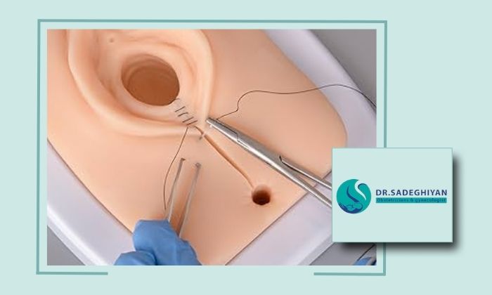  جراحی پرینورافی چگونه انجام می شود؟ و بهترین جراح آن در یزد