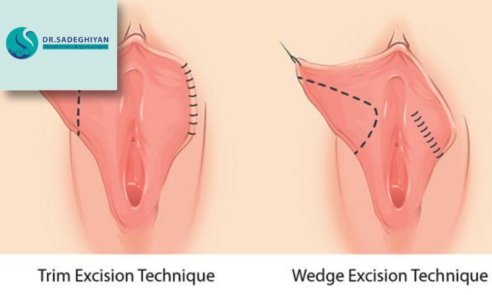 روش های انجام