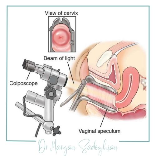لیزر زخم دهانه رحم چیست؟