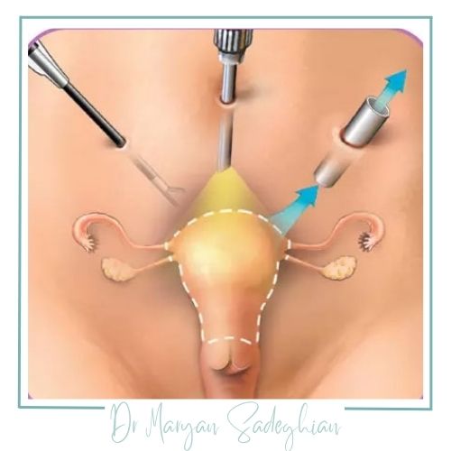 انواع هستروکتومی