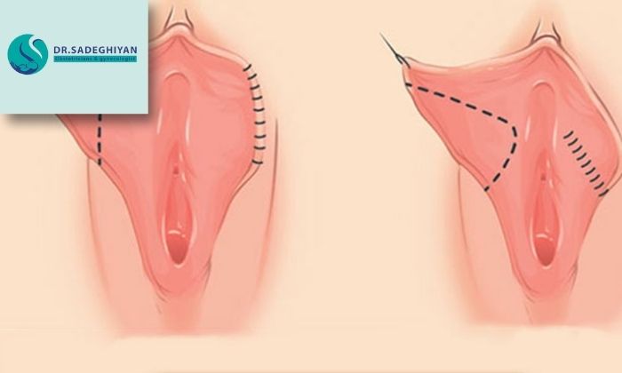 مراقبت‌های پس از تنگ کردن واژن با جراحی