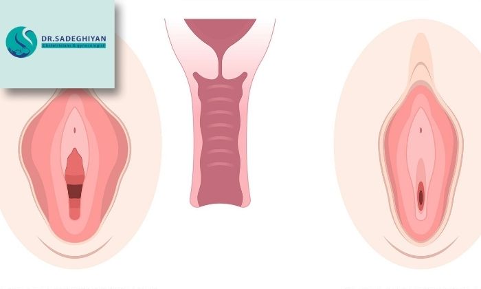 دلایل انجام عمل تنگی واژن