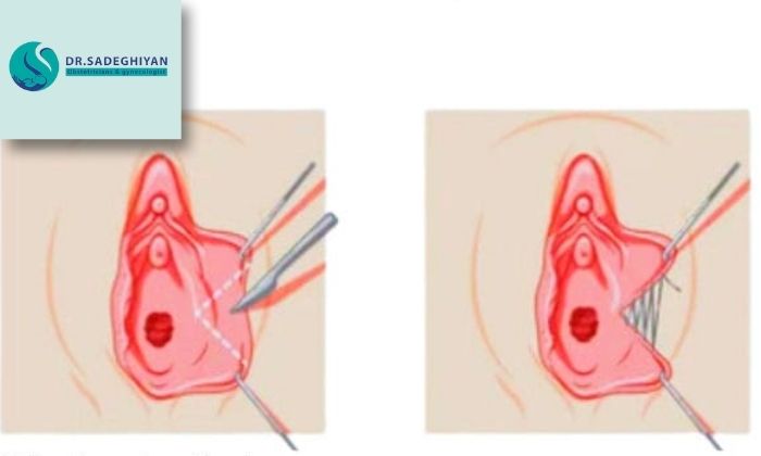 فرآیند عمل زیبایی واژن 