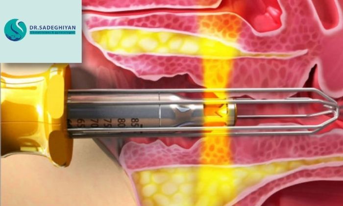 مزایای این روش