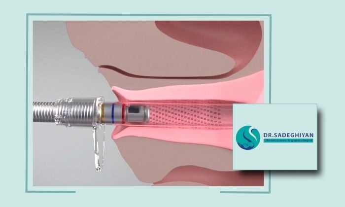 لیزر عفونت واژن در یزد توسط پزشک متخصص