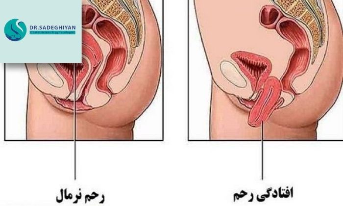 دلایل پرولاپس رحم
