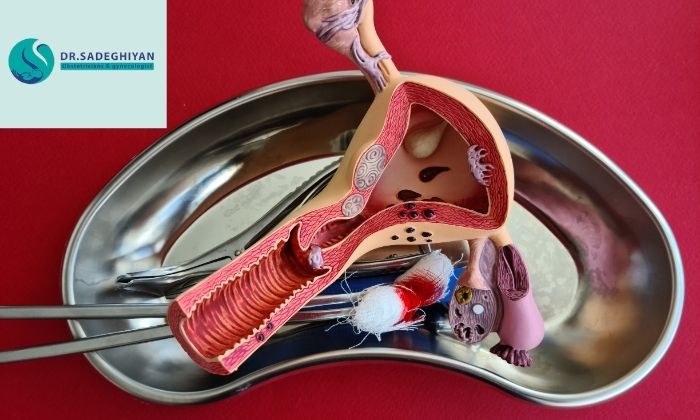 چه بیماری‌هایی نیاز به برداشتن رحم دارند؟