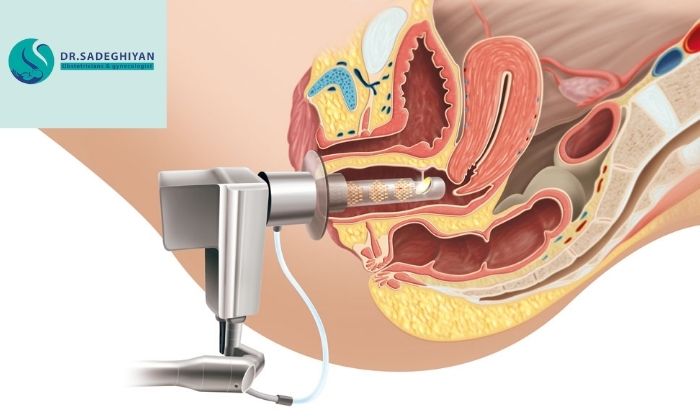 لیزر واژن چطور به درمان خشکی واژن کمک می کند؟