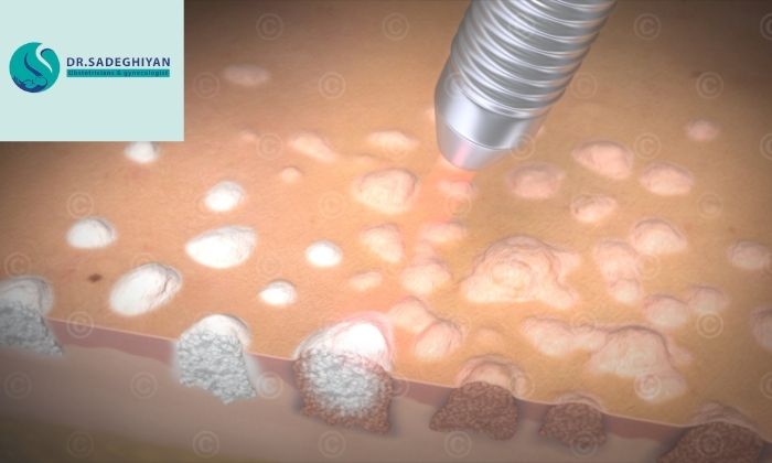 درمان زگیل تناسلی