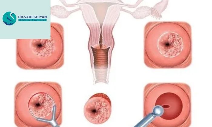 درمان زخم دهانه ی رحم