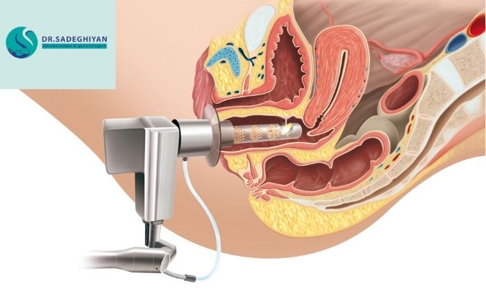 درمان عفونت های مکرر واژن