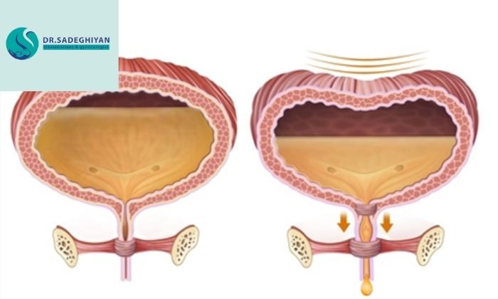 درمان بی اختیاری ادراری