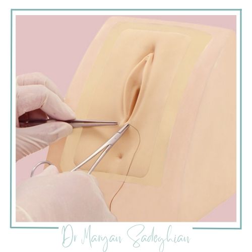 جراحی پرینورافی