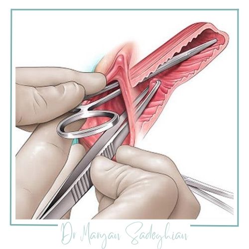 هزینه جراحی پرینه