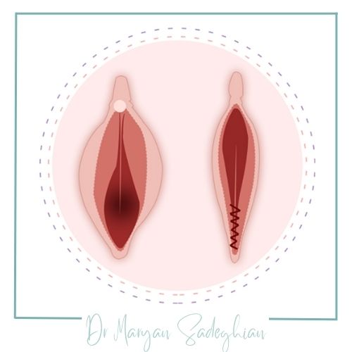 آمادگی قبل از جراحی پرینه