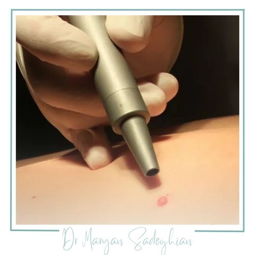 مزایای استفاده از لیزر