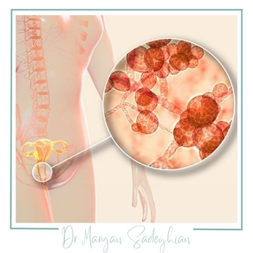 عوامل منجر به عفونت‌های واژن 