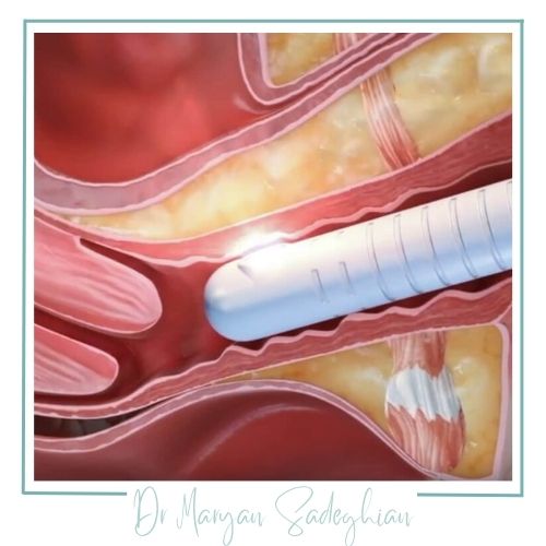 درمان عفونت‌ها با لیزر