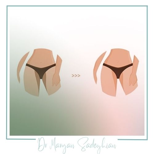 کربوکسی تراپی واژن برای رفع تیرگی