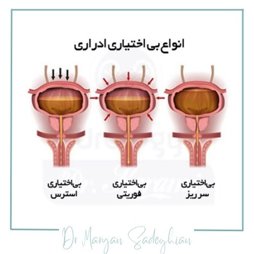 انواع بی‌اختیاری ادرار
