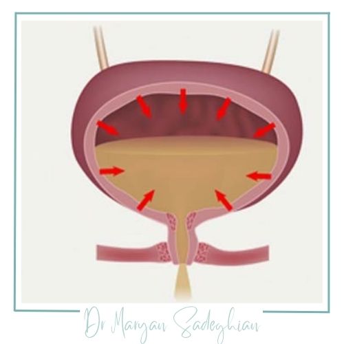 دلایل عدم کنترل ادرار