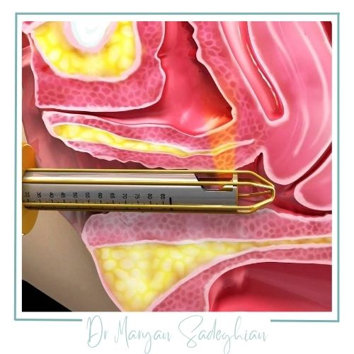 لیزر درمانی برای بی‌اختیاری ادرار