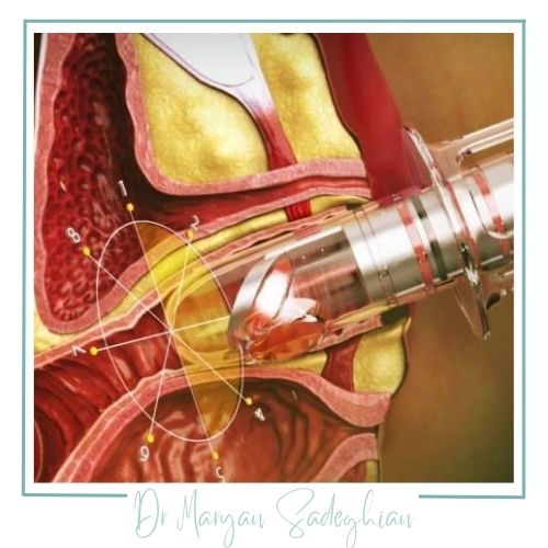 تأثیرات لیزر در کنترل بی‌اختیاری