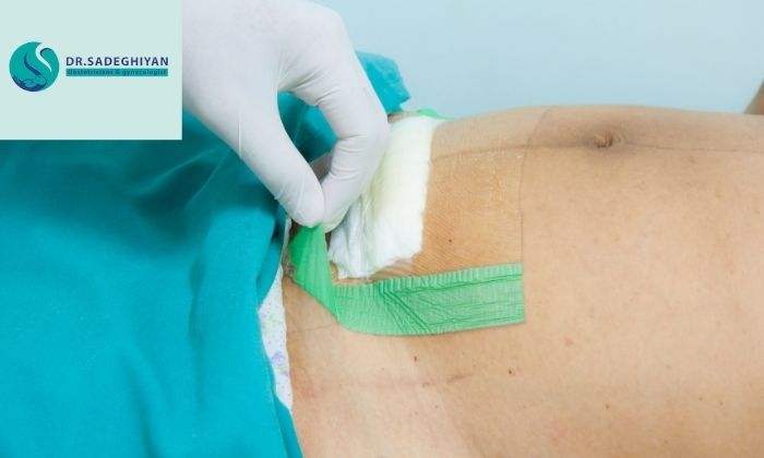 مراقبت از محل بخیه بعد از سزارین