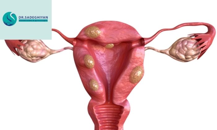 آیا جراحی تنها راه درمان فیبروم‌های رحمی است؟