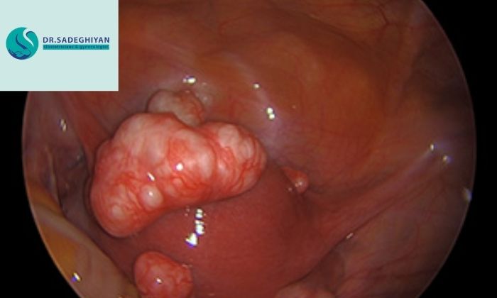 انواع فیبروم‌های رحمی و علائم آن‌ها