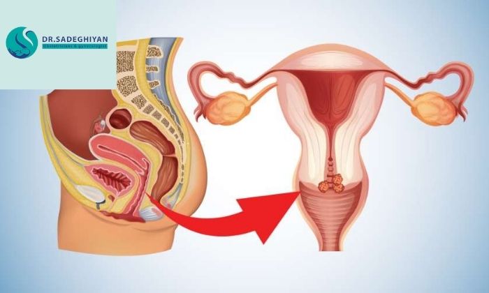 عوامل ایجاد زخم دهانه‌ رحم 
