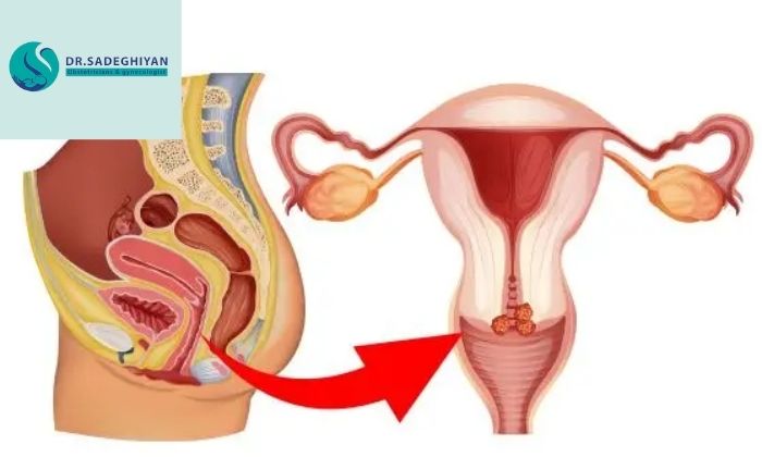 زخم دهانه رحم باعث سرطان میشود؟ زخم دهانه رحم باعث سرطان میشود؟