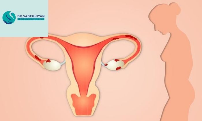 جلوگیری از تبدیل زخم دهانه رحم به سرطان جلوگیری از تبدیل زخم دهانه رحم به سرطان