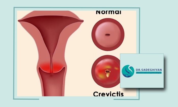 آیا زخم دهانه رحم می‌تواند منجر به ناباروری شود یا خیر؟