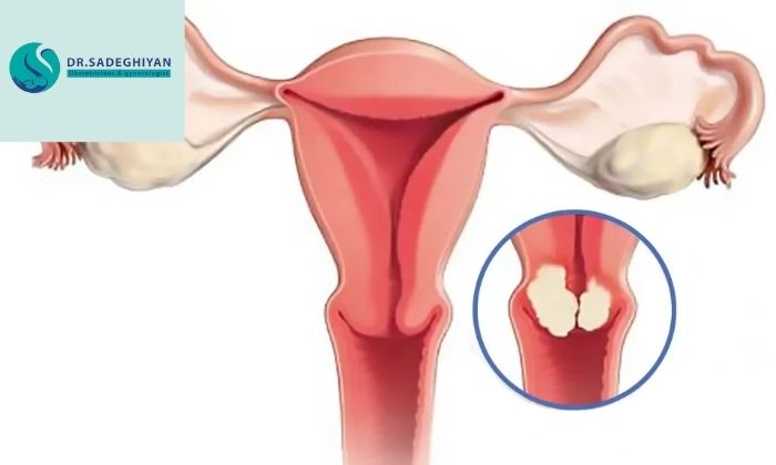 عفونت جنسی چطور باعث زخم دهانه رحم می‌شود؟
