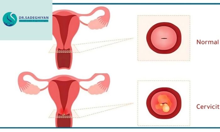 علائم زخم دهانه رحم ناشی از عفونت