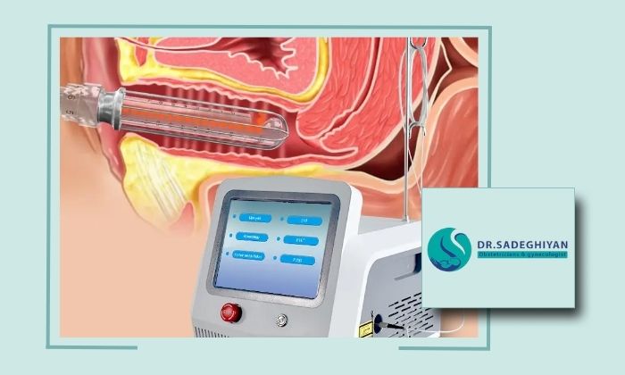 چطور لیزر جوانسازی واژن می‌تواند افتادگی واژن را درمان کند؟