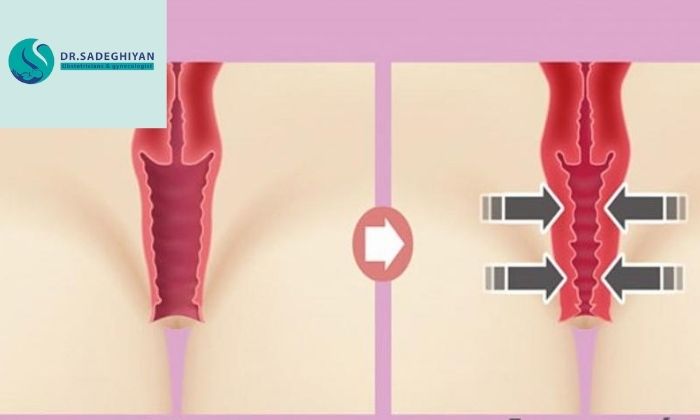 روند انجام درمان لیزر جوانسازی واژن