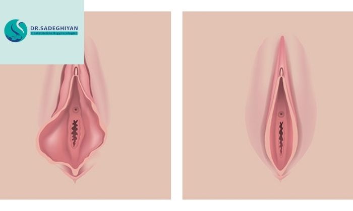 آیا جراحی برای افتادگی واژن بهتر از لیزر است؟