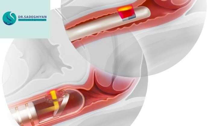 کاندیدای مناسب لیزر