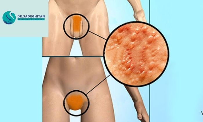 چگونه عفونت مقاربتی را بشناسیم و درمان کنیم؟
