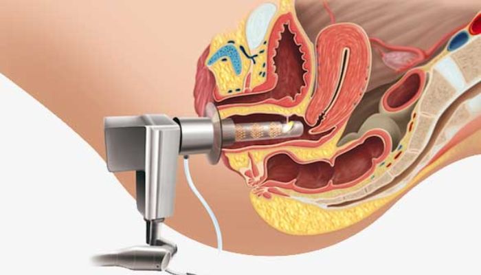 درمان عفونت های مکرر واژن با لیزر 