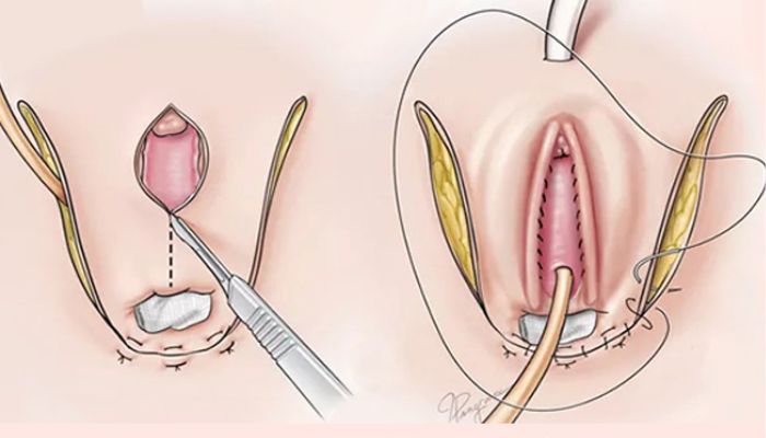 لیفت واژن با نخ