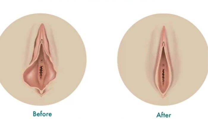 واژینوپلاستی