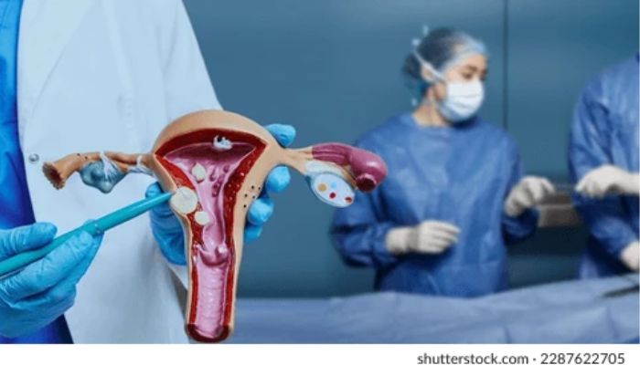جراحی برداشتن رحم و فیبروم