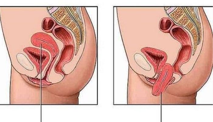 رفع افتادگی رحم 