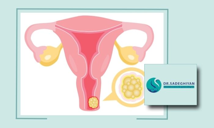 آیا زخم دهانه رحم می‌تواند منجر به سرطان شود؟