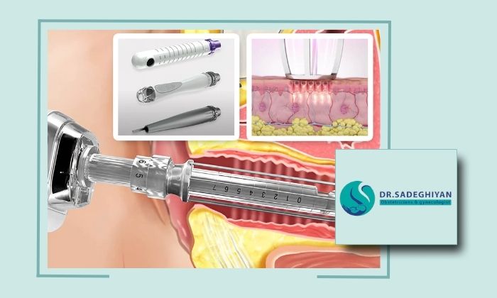 آیا لیزر درمان افتادگی واژن به اندازه جراحی مؤثر است؟ مقایسه روش‌ها و نتایج