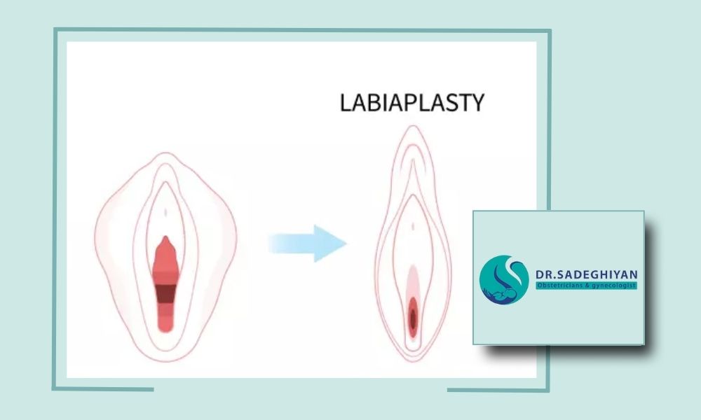 لابیاپلاستی در یزد توسط بهترین پزشک متخصص خانم با روش های جدید