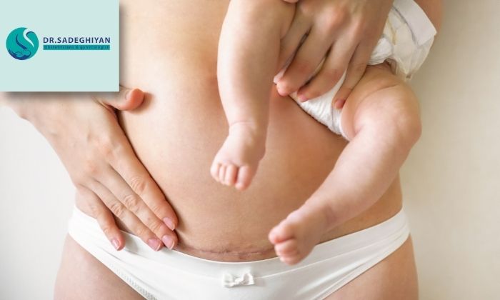 تفاوت‌های کلیدی سزارین و زایمان طبیعی